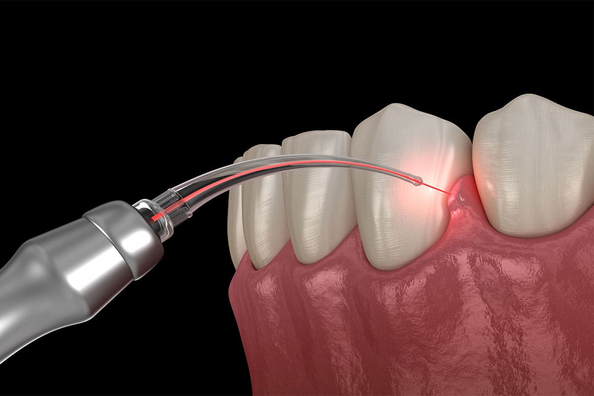 Laser Dentistry