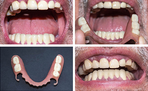 Partial dentures 1