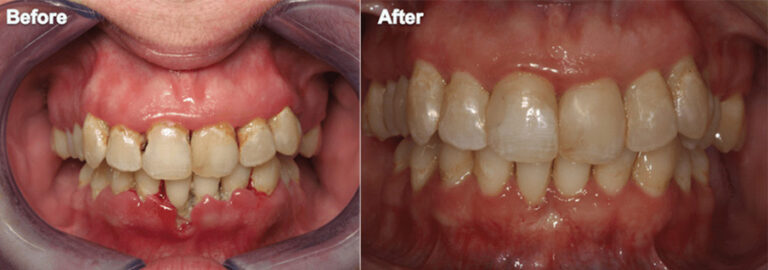 Periodontal Surgery and Restorative