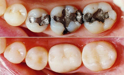 composite fillings 1