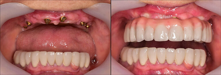 dental implant overdenture 1