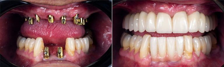 dental implants 1