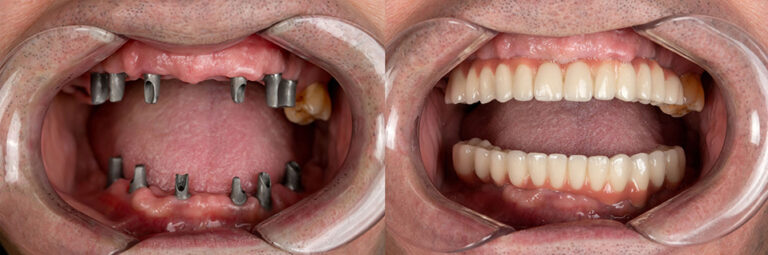 full mouth rehabilitation 1