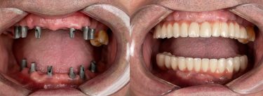 dental implant surgery in delhi india