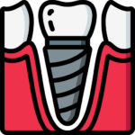 dental implants